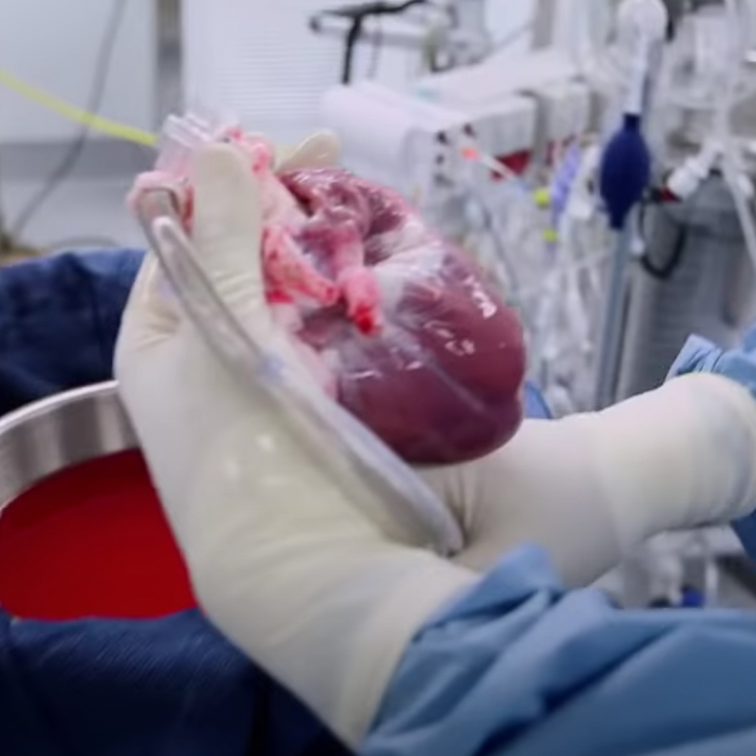 Heart Transplantation – Primary Anatomy Surgical educational video of heart transplantation surgery and heart preservation with the transmedic organ care system
