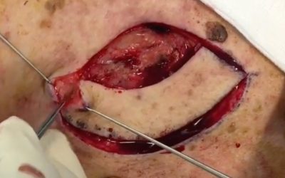 The Keystone Perforator Island Flap