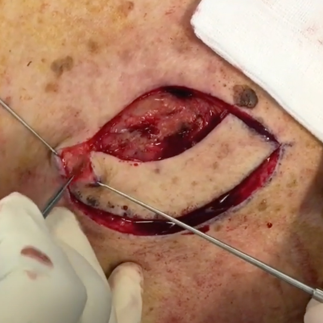 The Keystone Perforator Island Flap How to perform a keystone flap - surgical education video