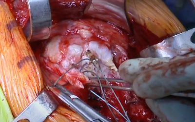 The Reverse Total Shoulder Replacement