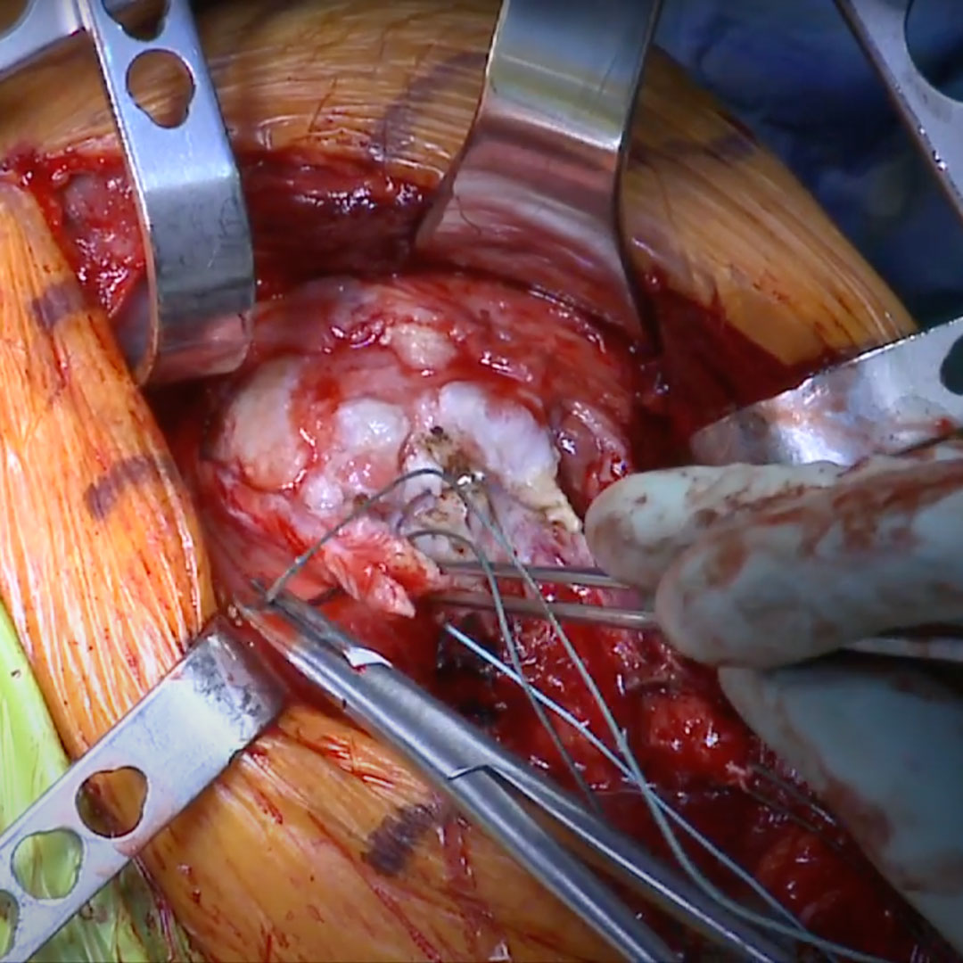 The Reverse Total Shoulder Replacement surgical education video of a reverse total shoulder replacement operation.