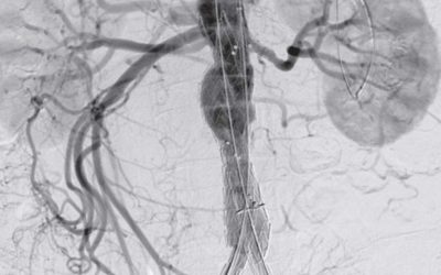 Endovascular Arterial Repair (EVAR)