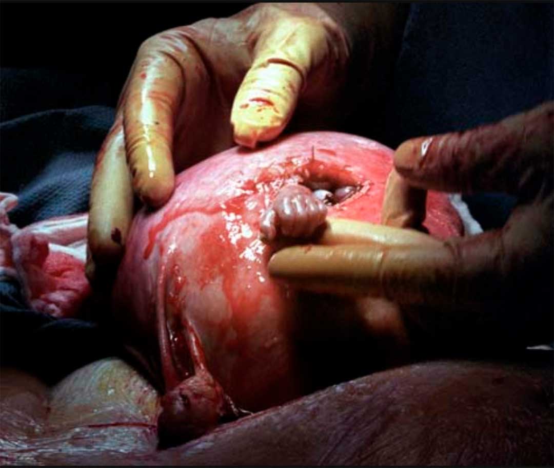 Hand of Hope In-utero surgery to inspire future surgeons