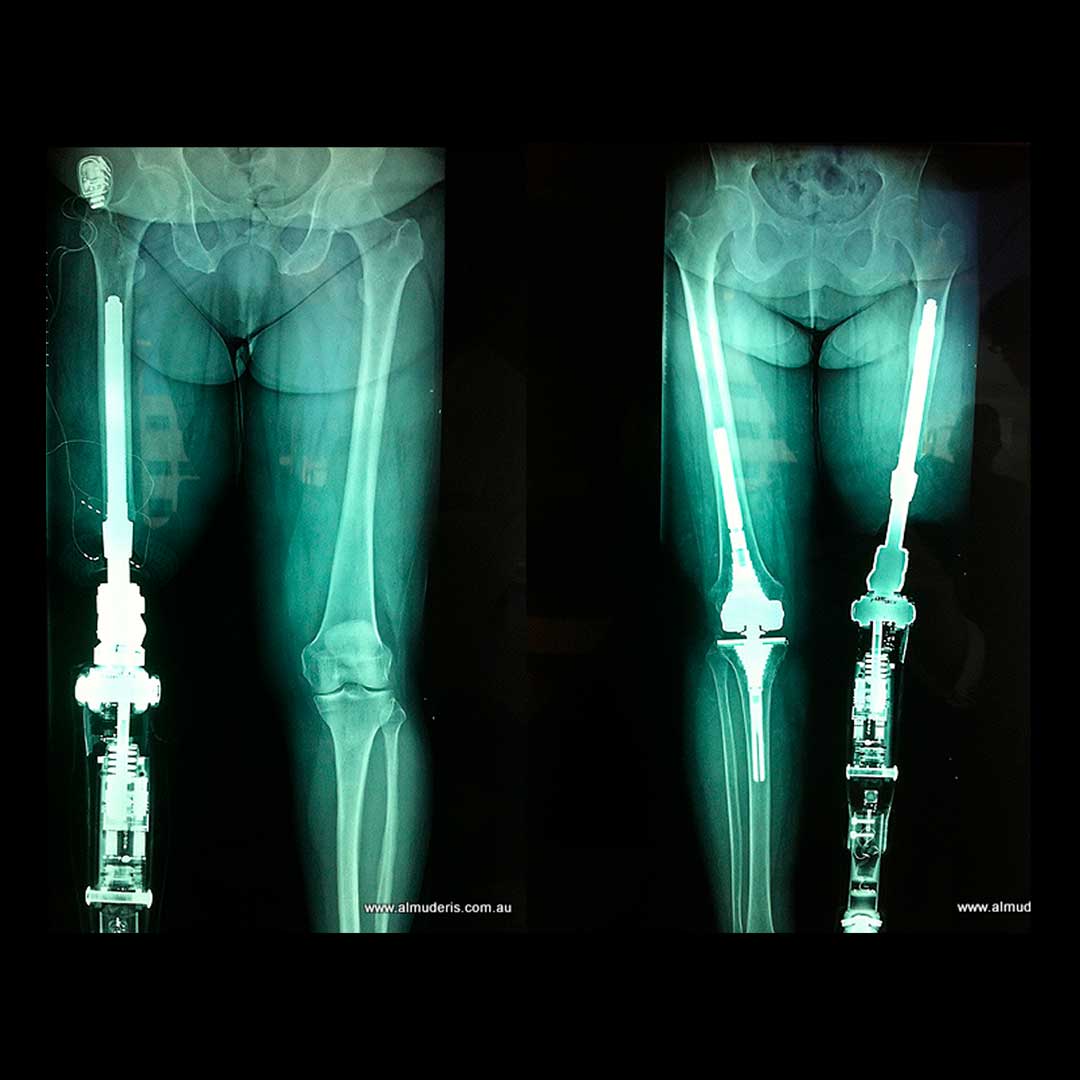 Osseointegration Surgical education for orthopaedic surgeons with regards to osseointegration and limb prosthesis