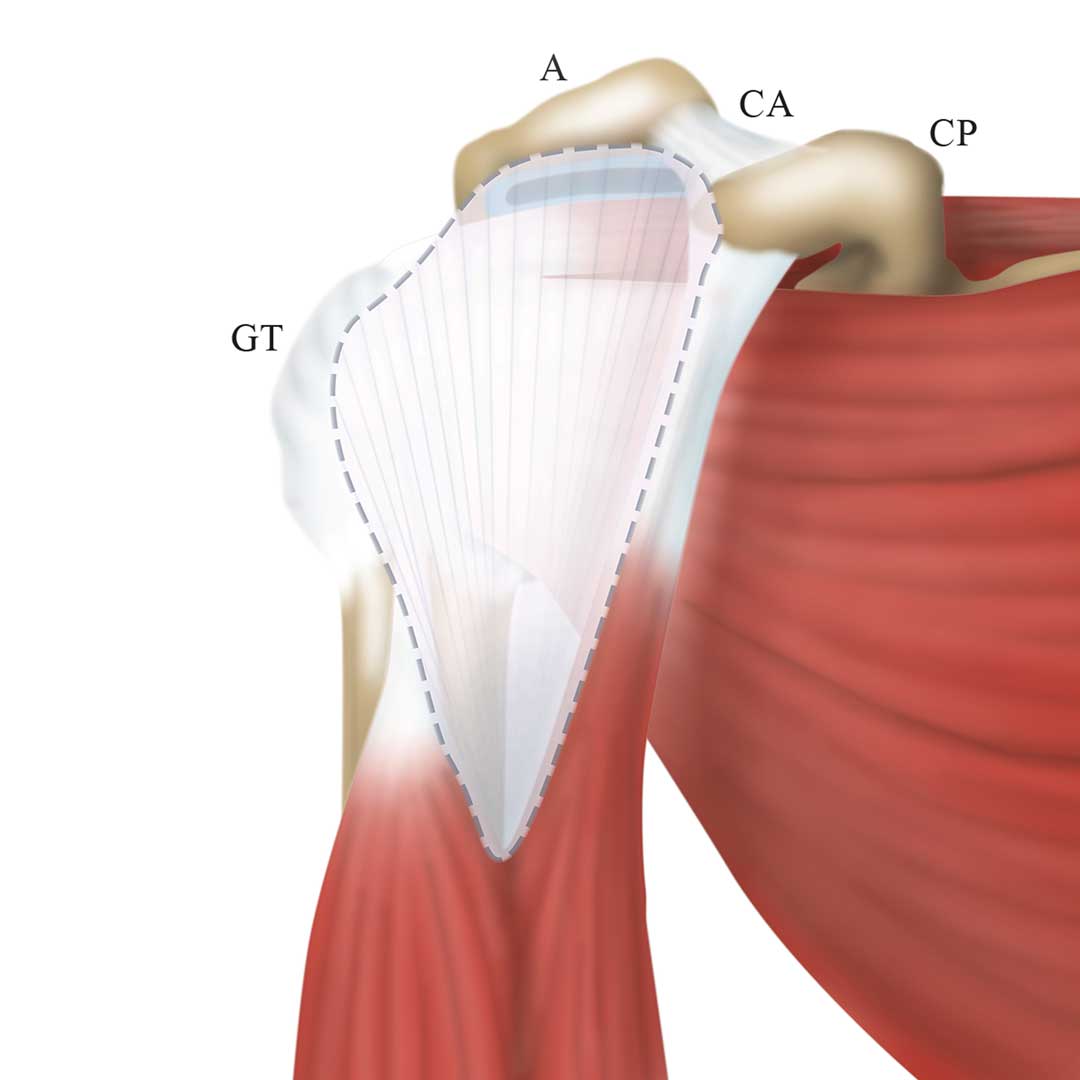 GSSE anatomy illustrations – unusual variant of Biceps Brachii – Primary Anatomy Orthopaedic and Anatomy education - variant of the Biceps Brachii muscle