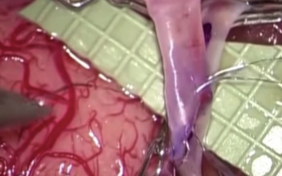 Cerebral Bypass Surgery