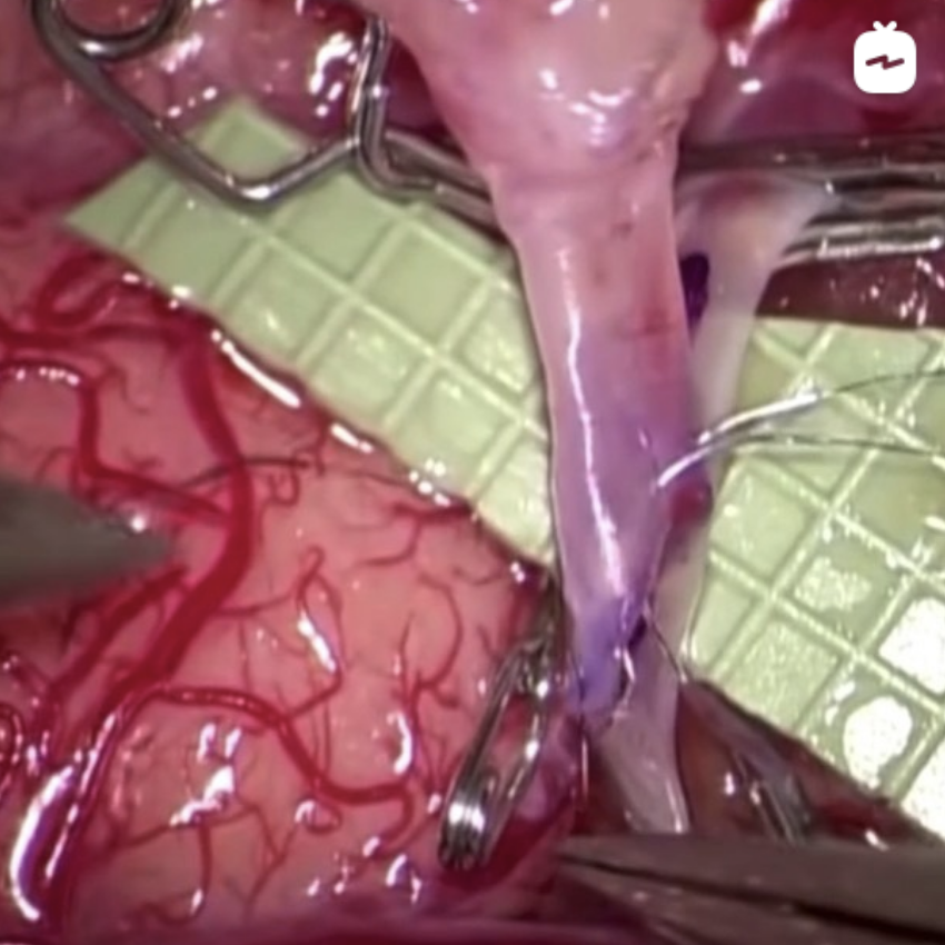 Cerebral Bypass Surgery Surgical education for cerebral bypass surgery - neurosurgery