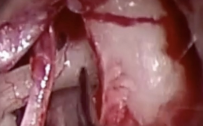 Stapedectomy For Otosclerosis