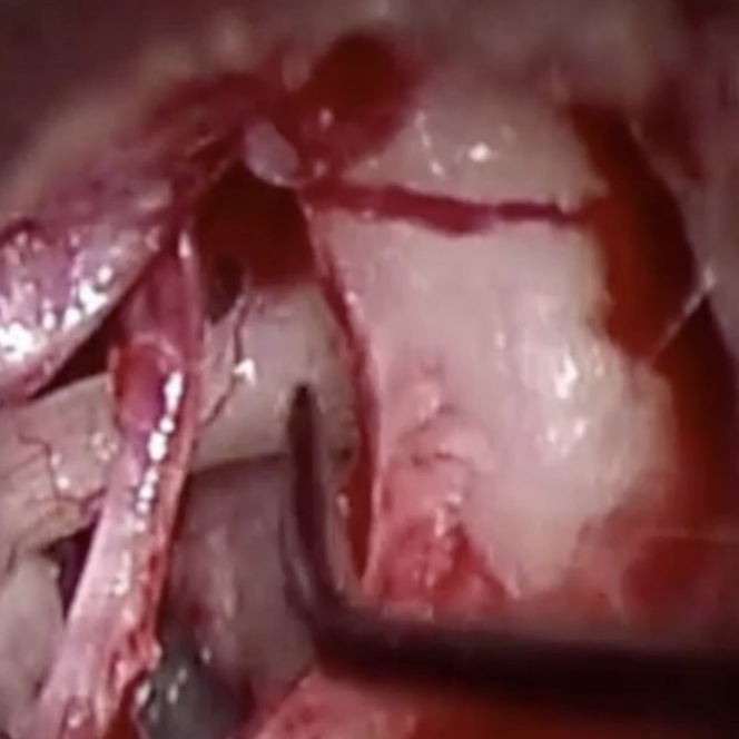 Stapedectomy For Otosclerosis Showing surgical trainees a stapedectomy operation