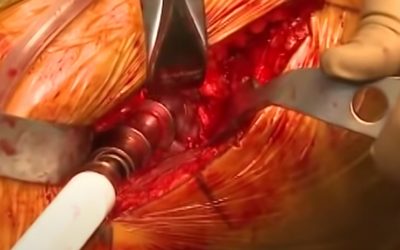 Total Hip replacement – Anterior Approach