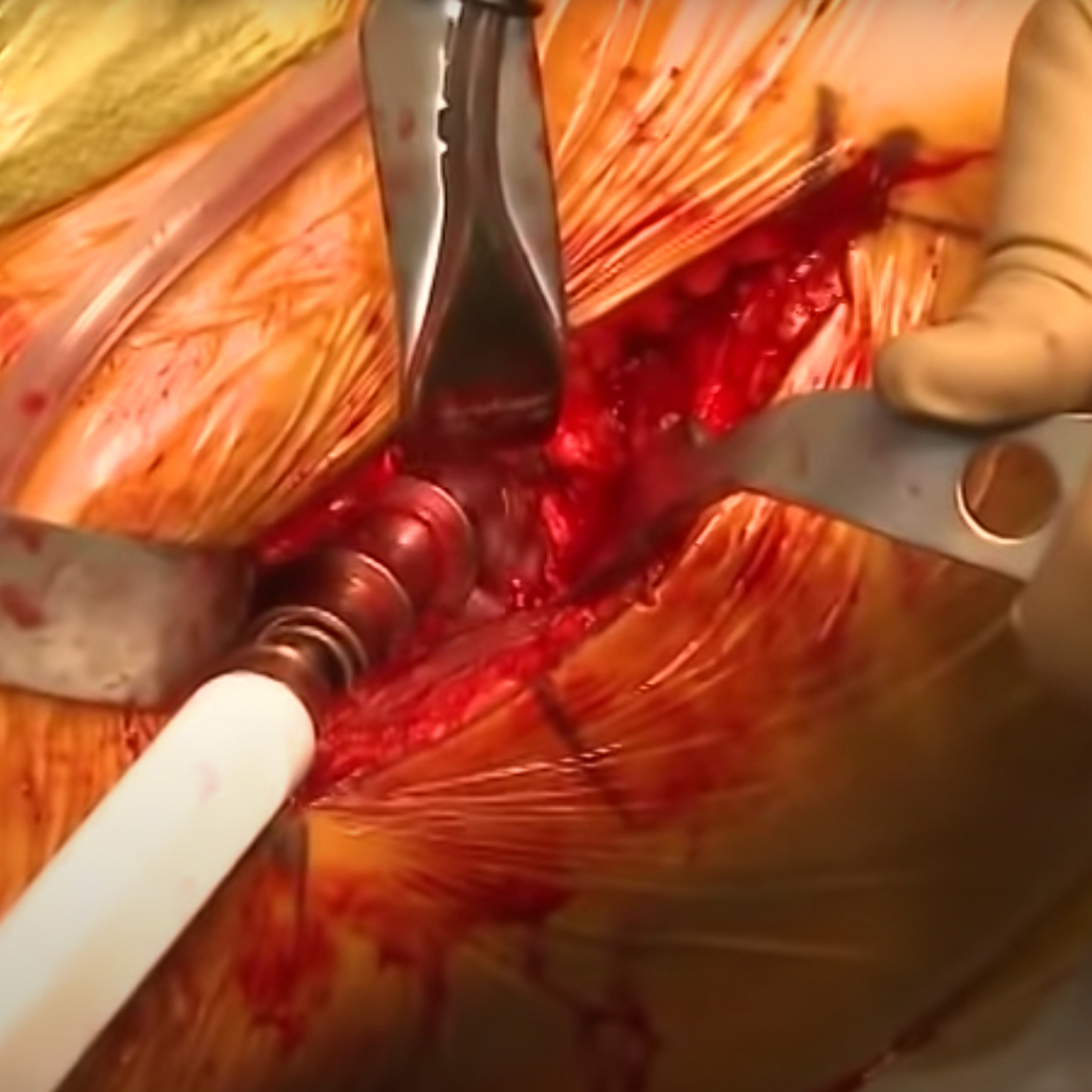 Anterior Total Hip Replacement-Video Video demonstrating a total hip replacement via the anterior approach