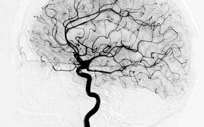 Cerebral Angiography