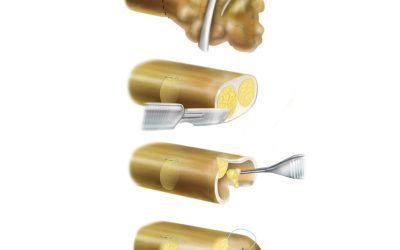 Novel Surgical Technique for Treating Neuromas