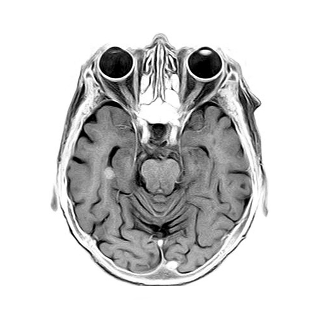 Gamma Knife (Stereotactic Radiosurgery) – Primary Anatomy – GSSE