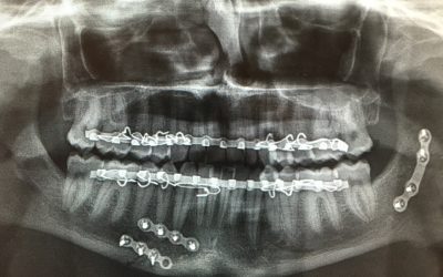 Mandibular Fractures – AO Foundation